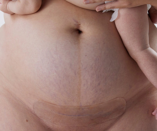 Silicone Gel Scar Strips